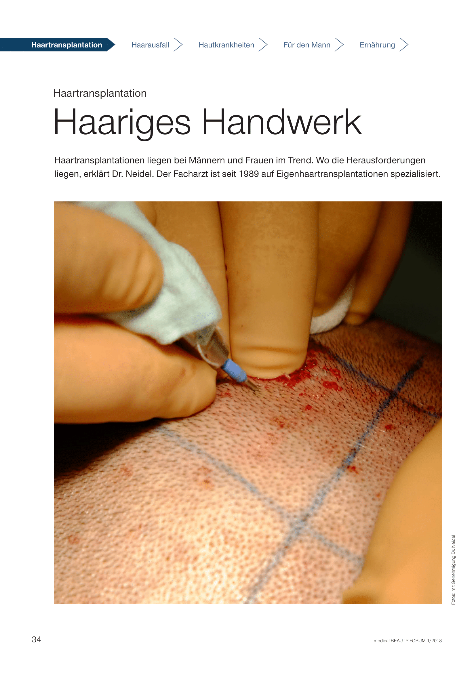 Haartransplantation Artikel